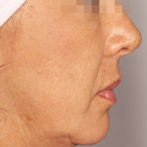 Aged skin after a GREEN PEEL Classic