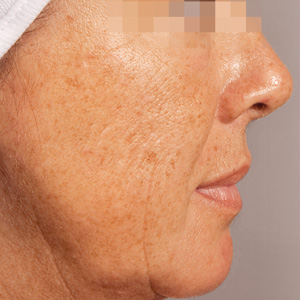 Aged skin before a GREEN PEEL Classic